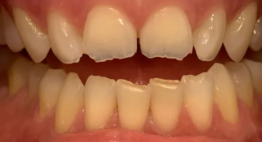 Carillas de cerámica en dientes anteriores — antes