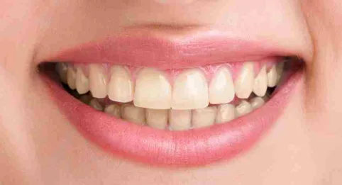 Ortodoncia con brackets estéticos — antes