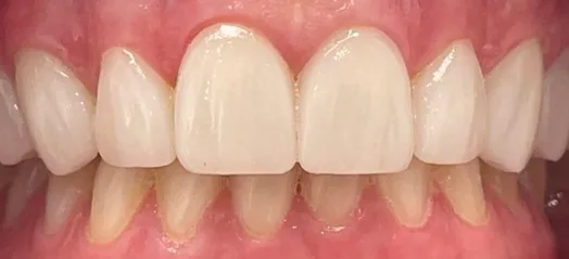 Carillas de cerámica en dientes anteriores — después